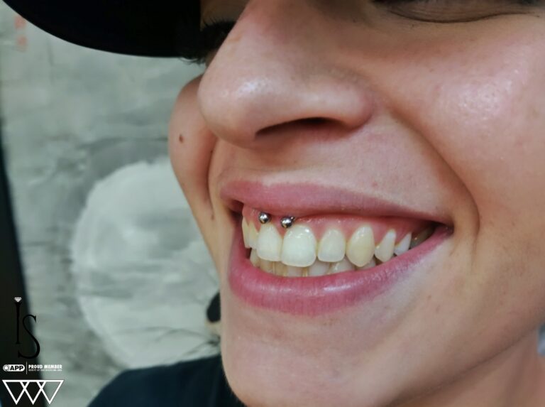 Smiley Piercing